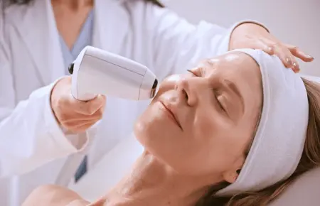 fine-lines-by-Sofwave